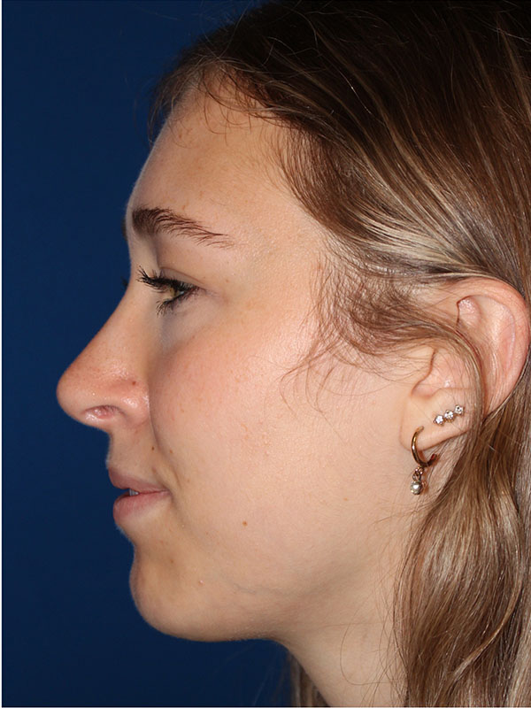 Female Cosmetic Rhinoplasty