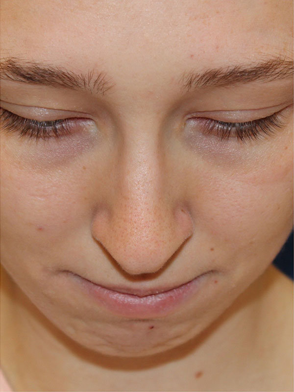 Female Cosmetic Rhinoplasty