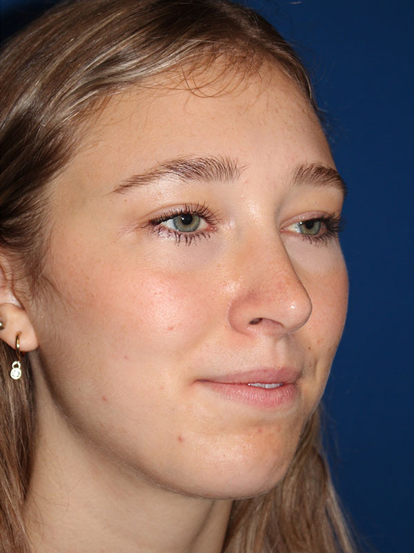 Female Cosmetic Rhinoplasty