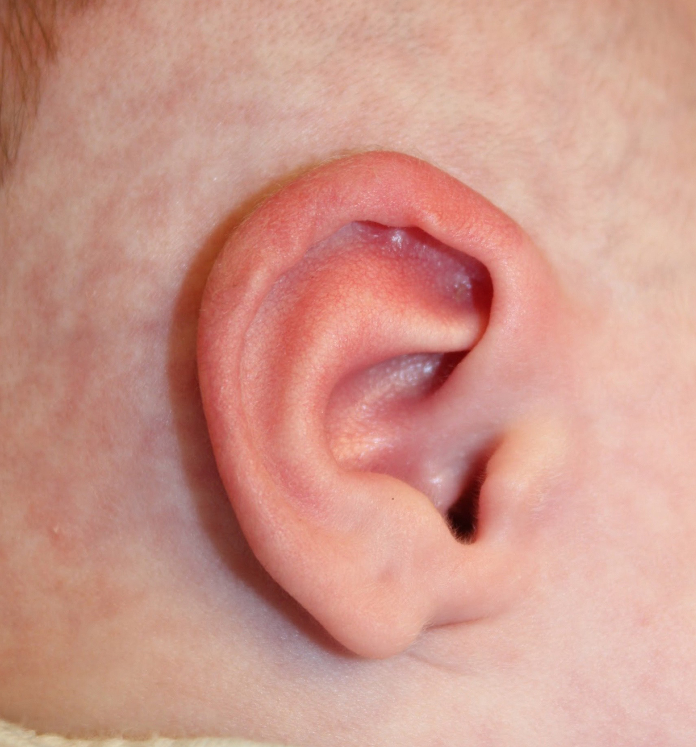 Ear Reshaping