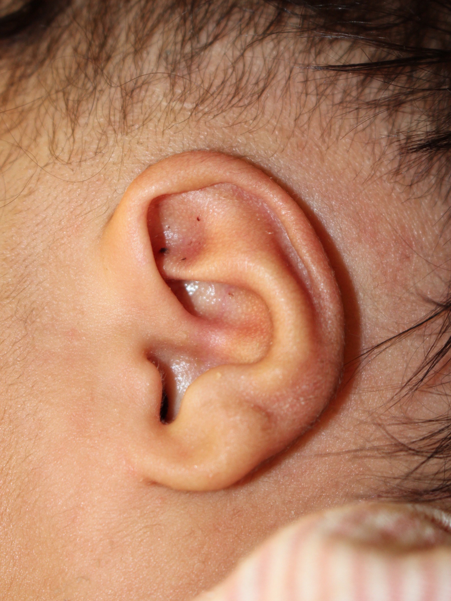 Ear Reshaping