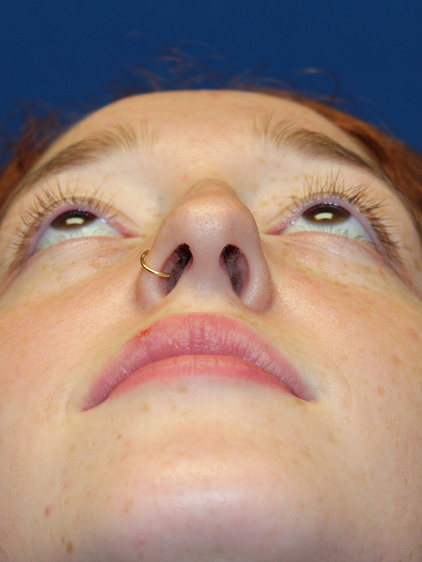 Female Cosmetic Rhinoplasty