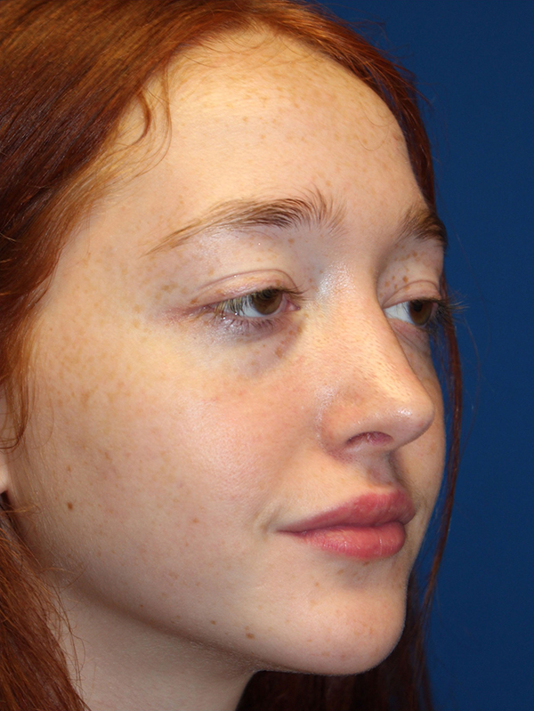 Female Cosmetic Rhinoplasty