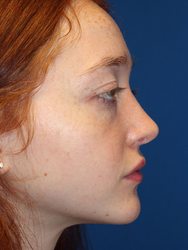 Female Cosmetic Rhinoplasty