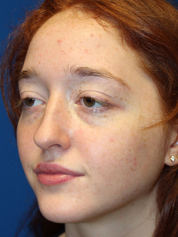 Female Cosmetic Rhinoplasty