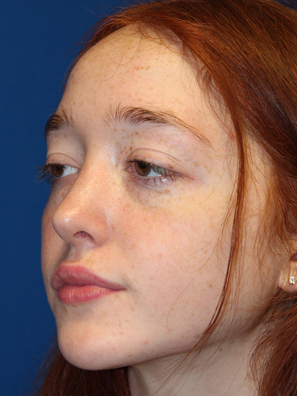 Female Cosmetic Rhinoplasty