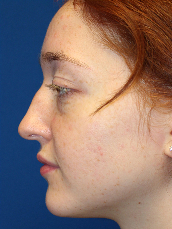 Female Cosmetic Rhinoplasty