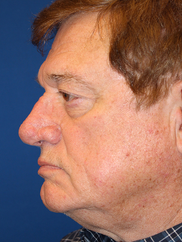 Male Cosmetic Rhinoplasty