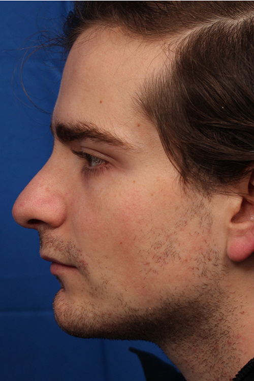 Male Cosmetic Rhinoplasty