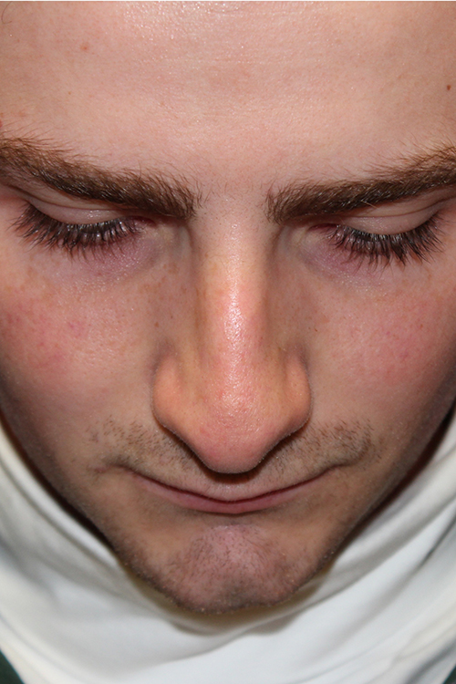 Male Cosmetic Rhinoplasty