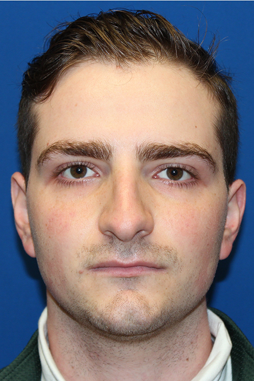 Male Cosmetic Rhinoplasty