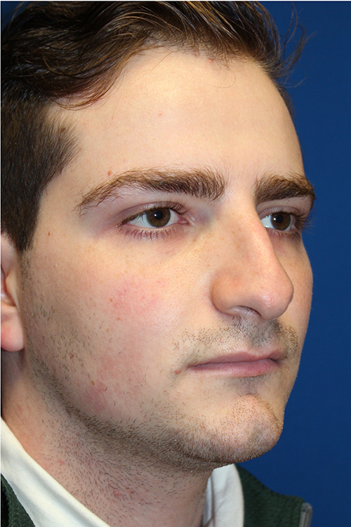 Male Cosmetic Rhinoplasty