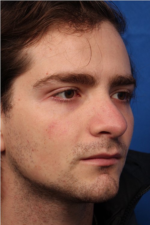 Male Cosmetic Rhinoplasty