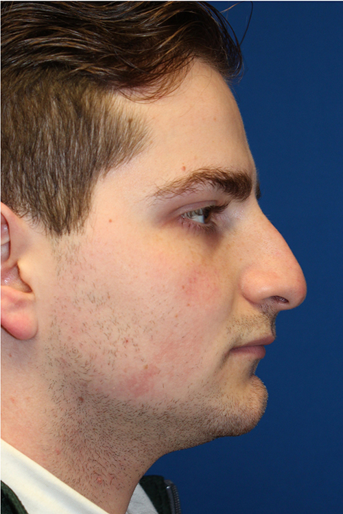 Male Cosmetic Rhinoplasty