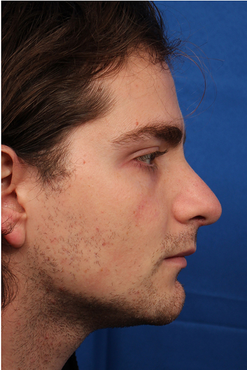 Male Cosmetic Rhinoplasty