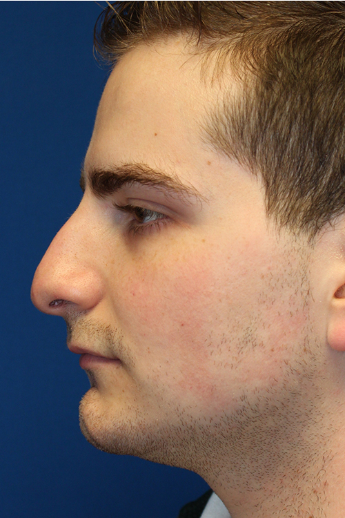 Male Cosmetic Rhinoplasty