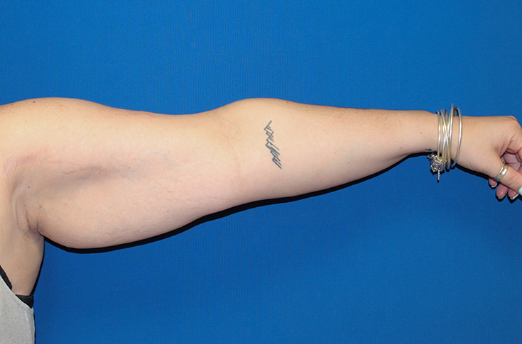 Non-Surgical Skin Tightening