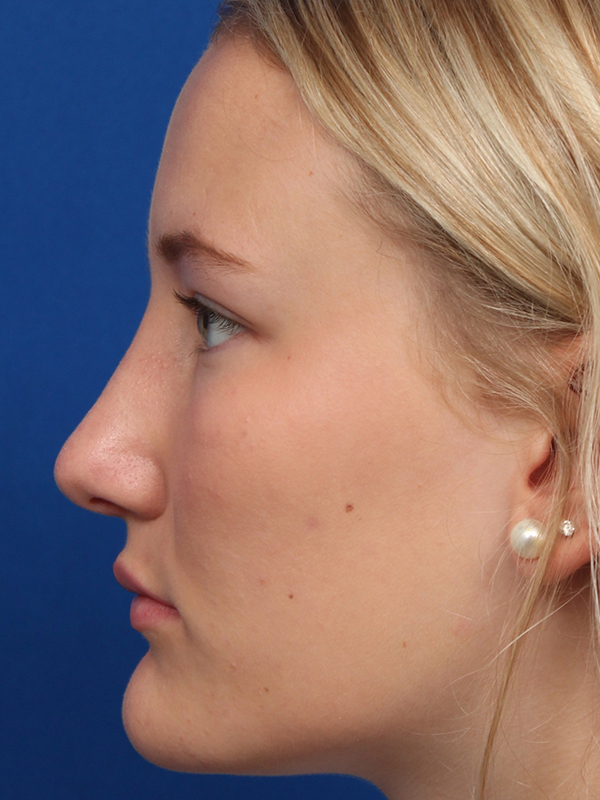 Female Cosmetic Rhinoplasty