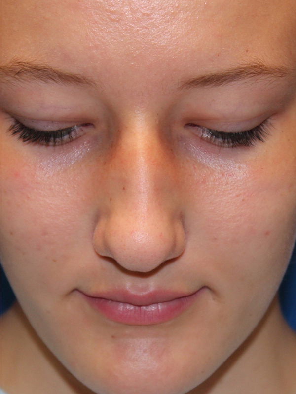 Female Cosmetic Rhinoplasty