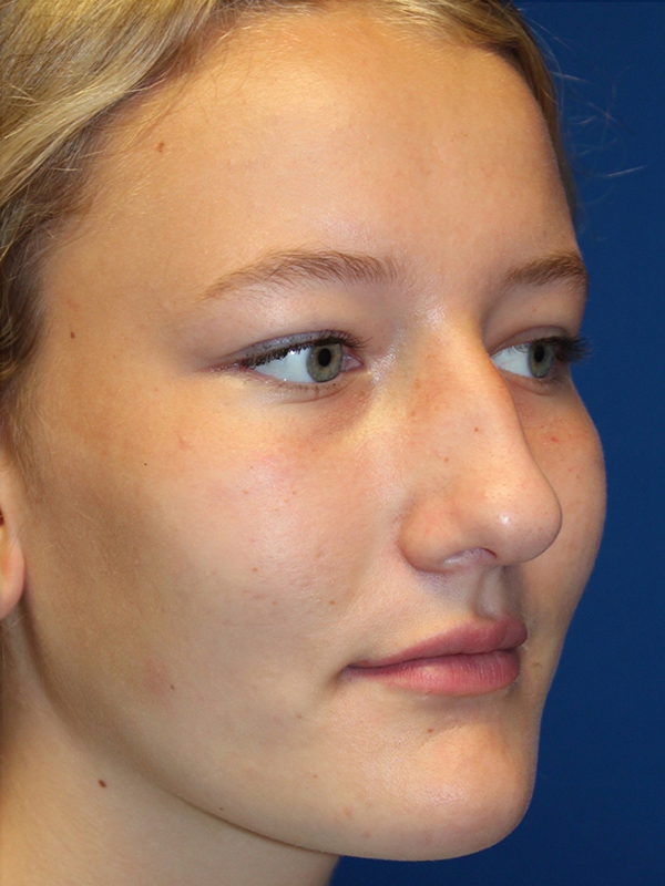 Female Cosmetic Rhinoplasty