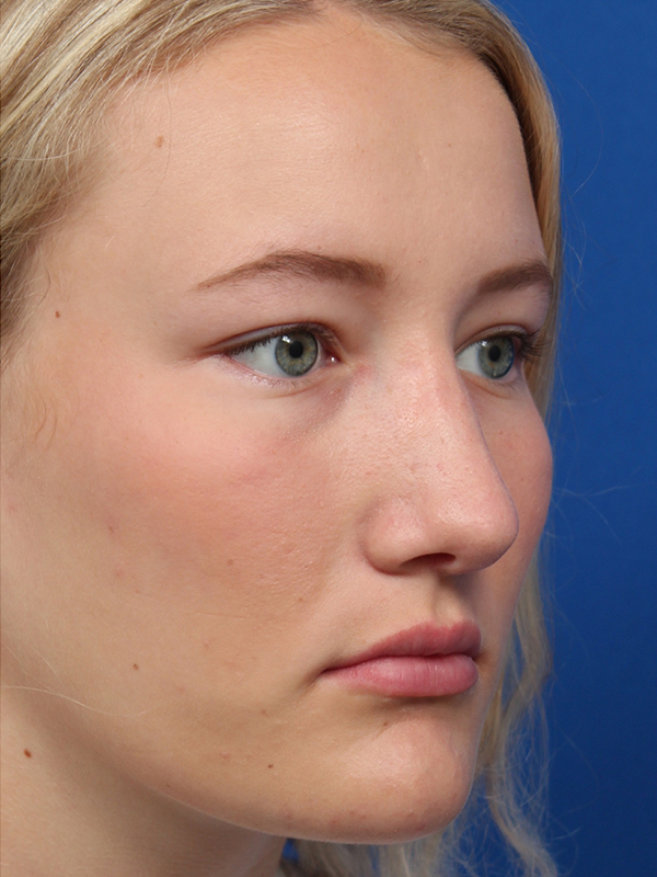 Female Cosmetic Rhinoplasty