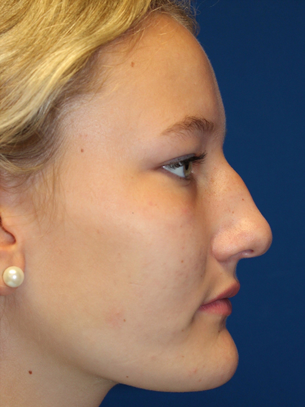 Female Cosmetic Rhinoplasty