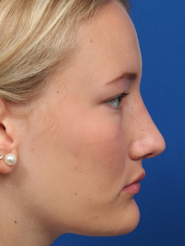 Female Cosmetic Rhinoplasty