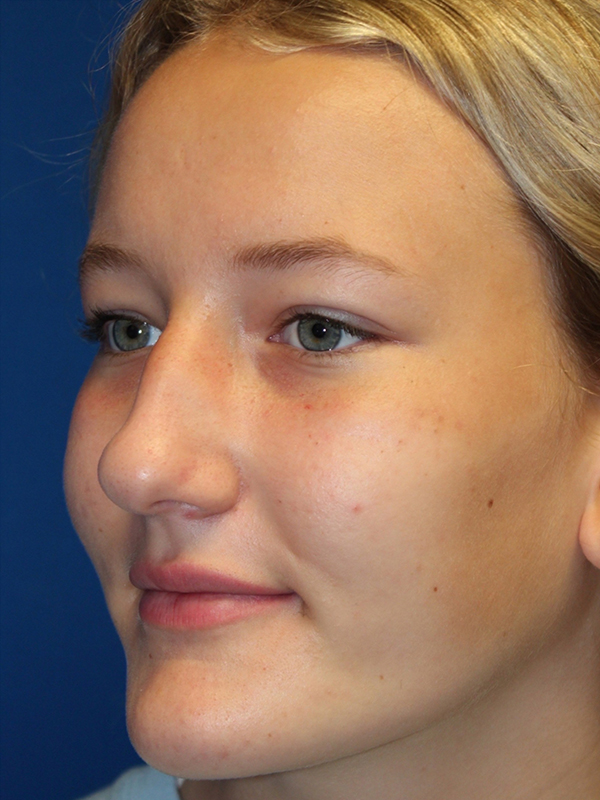 Female Cosmetic Rhinoplasty