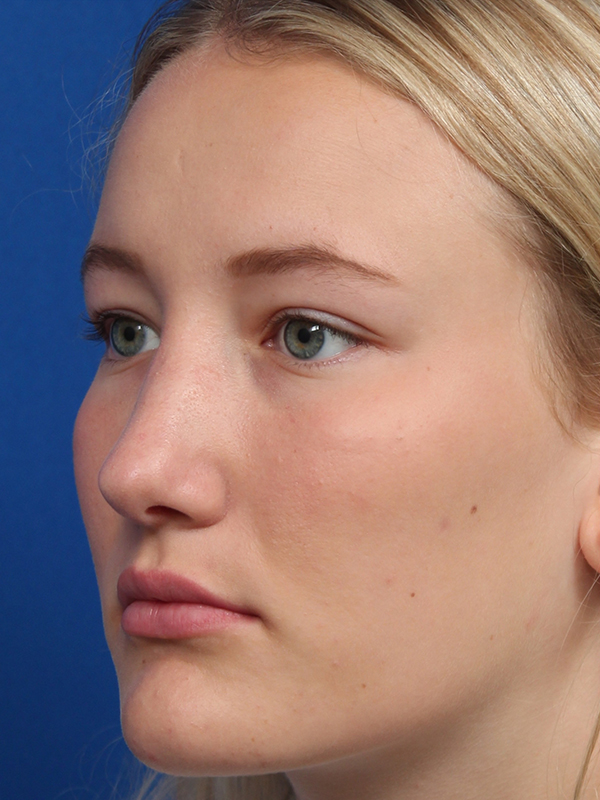 Female Cosmetic Rhinoplasty