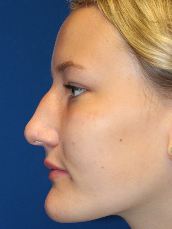 Female Cosmetic Rhinoplasty