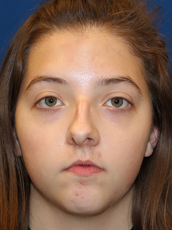 Female Cosmetic Rhinoplasty