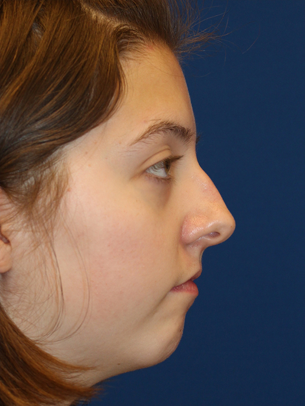 Female Cosmetic Rhinoplasty