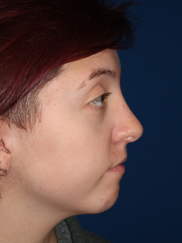 Female Cosmetic Rhinoplasty