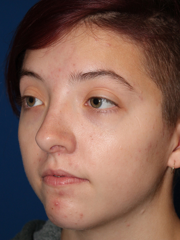 Female Cosmetic Rhinoplasty