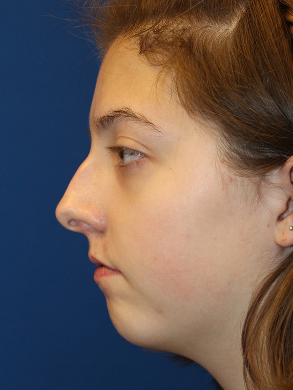 Female Cosmetic Rhinoplasty