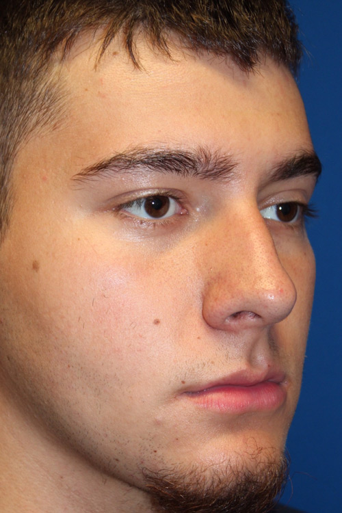 Male Cosmetic Rhinoplasty