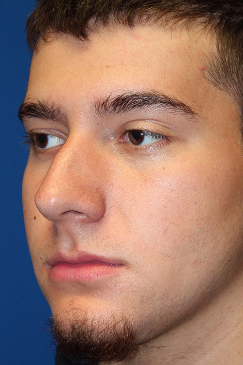 Male Cosmetic Rhinoplasty