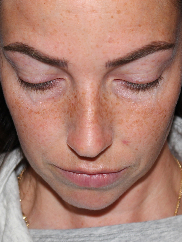 Female Cosmetic Rhinoplasty