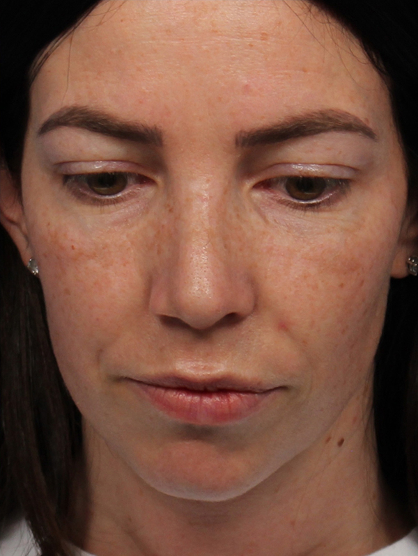 Female Cosmetic Rhinoplasty