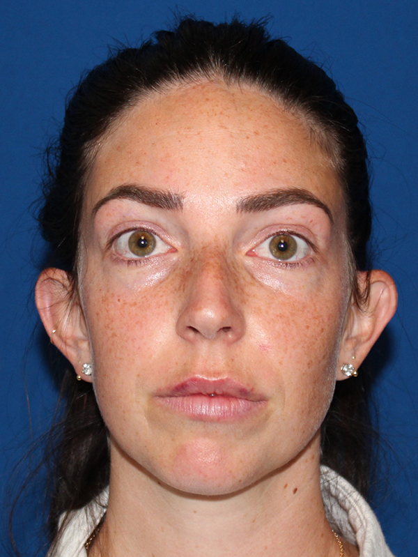 Female Cosmetic Rhinoplasty