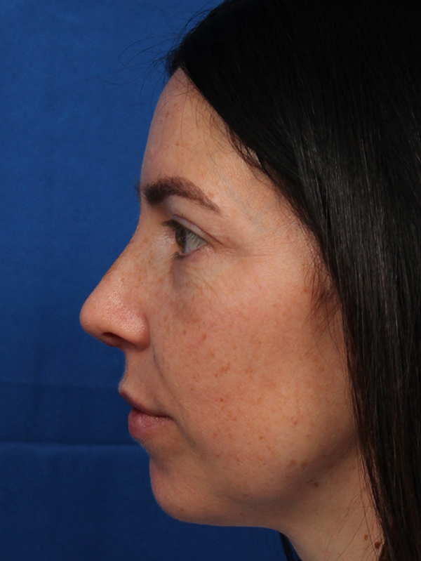 Female Cosmetic Rhinoplasty