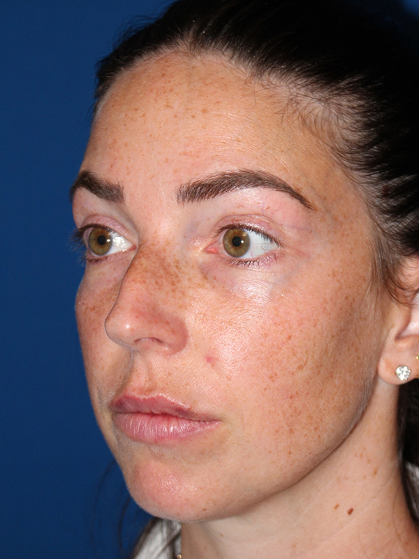 Female Cosmetic Rhinoplasty