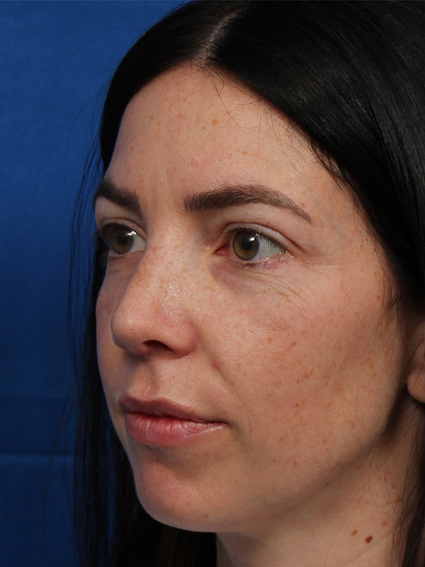 Female Cosmetic Rhinoplasty