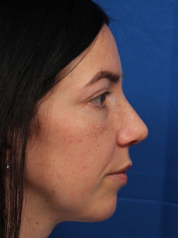 Female Cosmetic Rhinoplasty