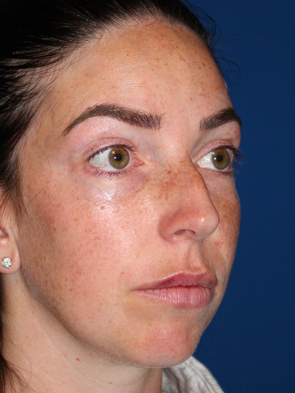 Female Cosmetic Rhinoplasty