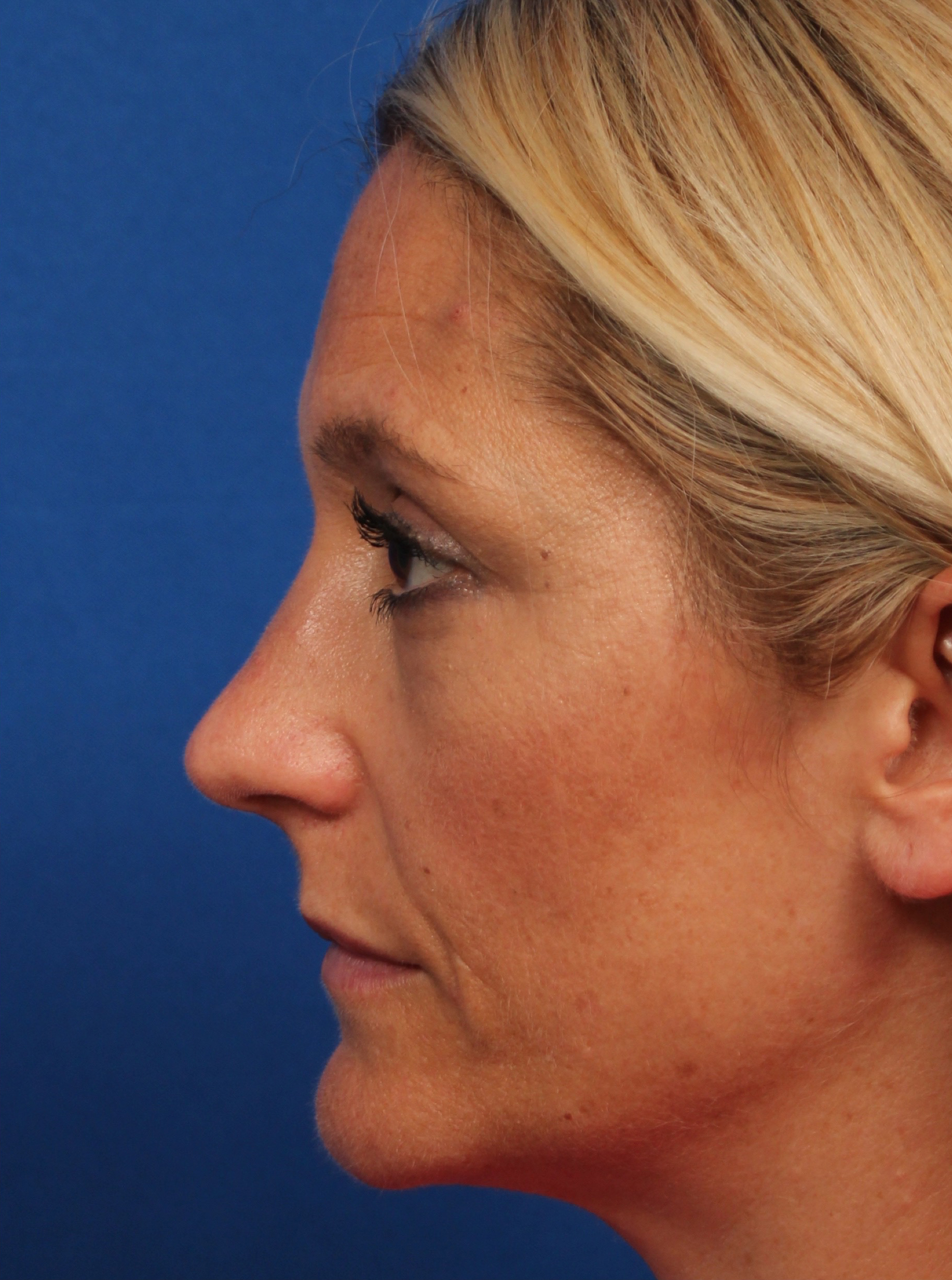 Female Cosmetic Rhinoplasty