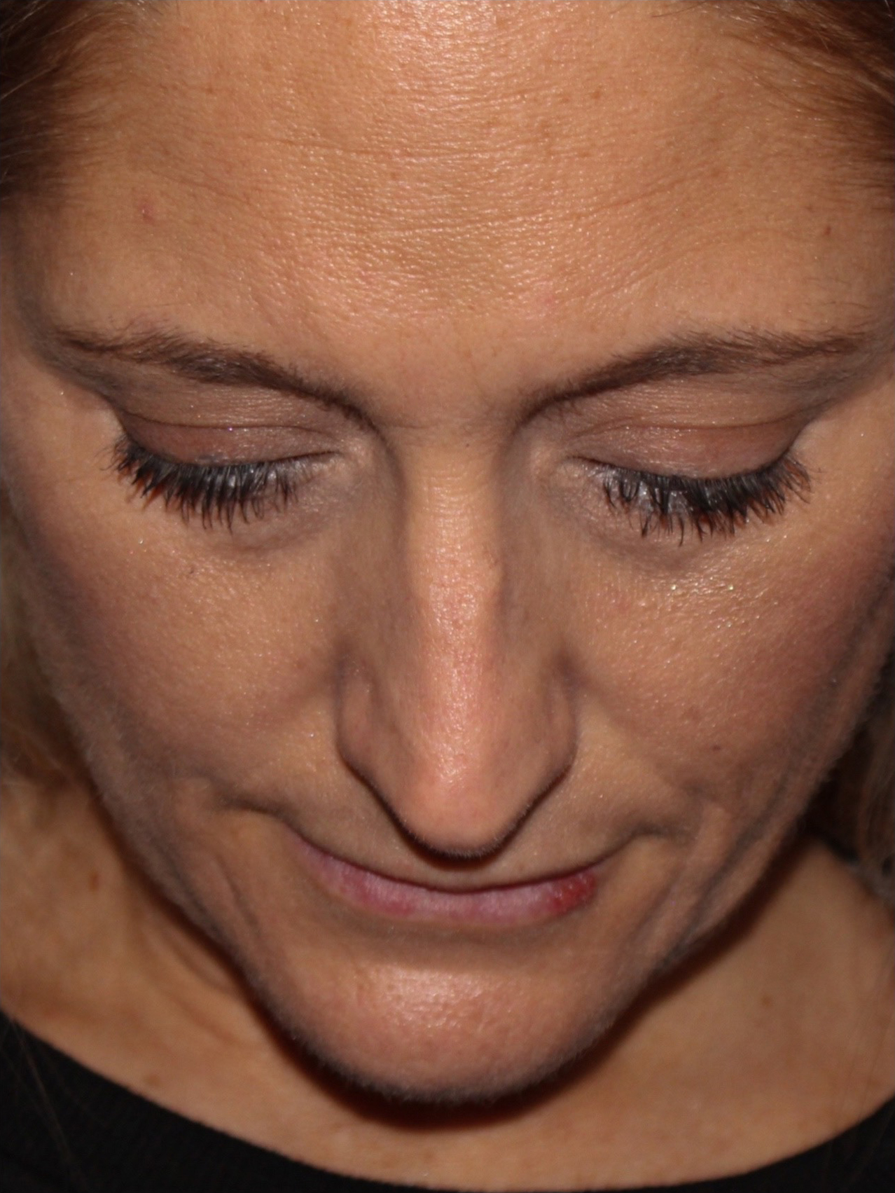 Female Cosmetic Rhinoplasty