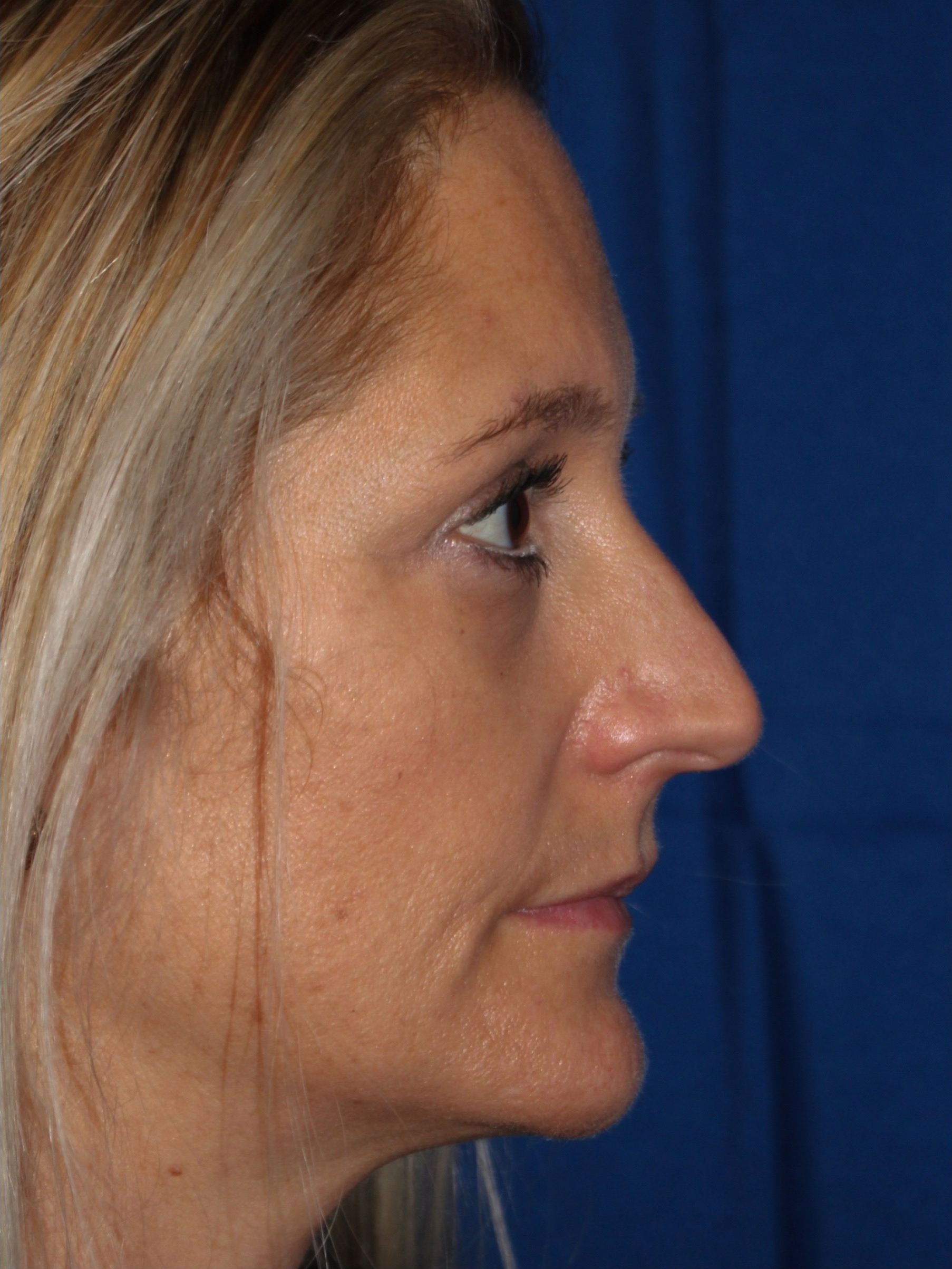 Female Cosmetic Rhinoplasty