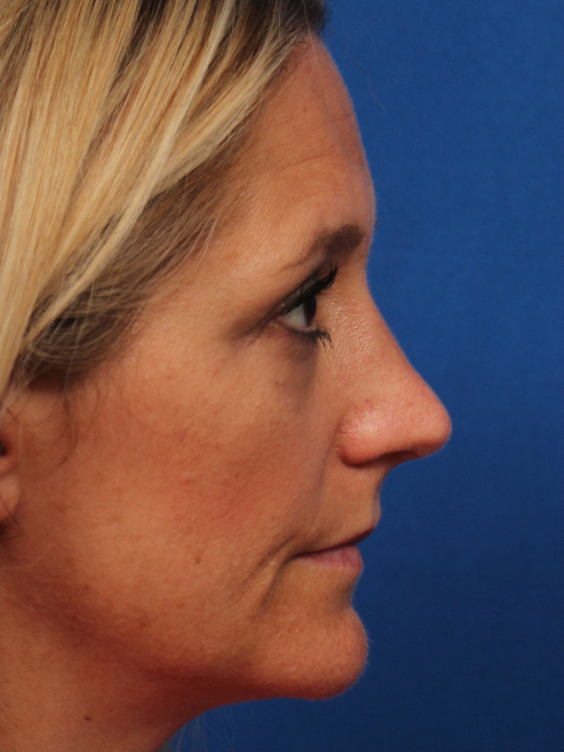 Female Cosmetic Rhinoplasty