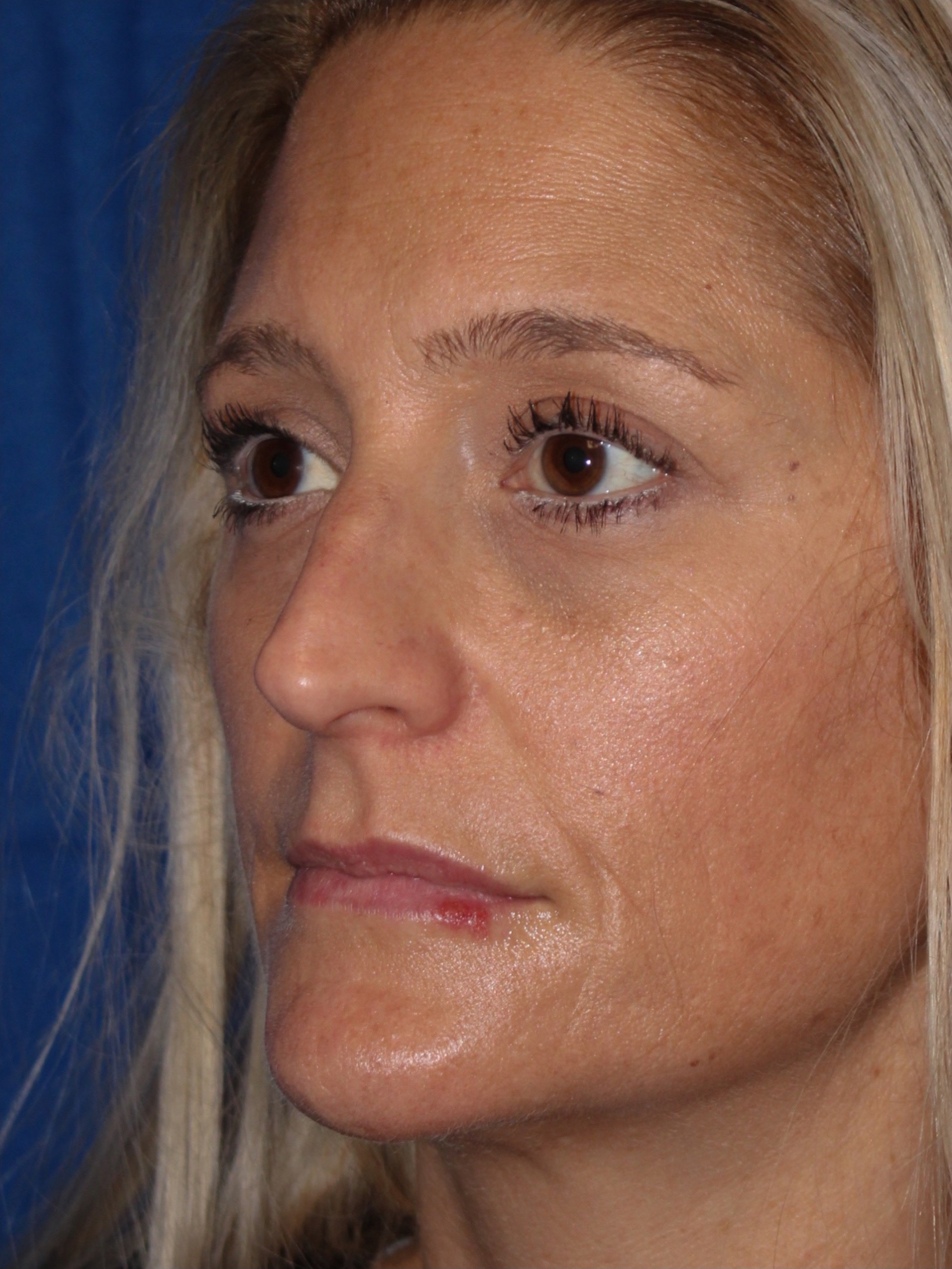 Female Cosmetic Rhinoplasty